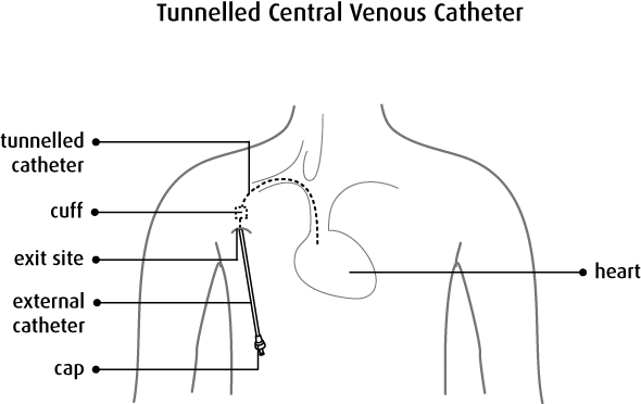 Tunnelled Central Venous Catheter