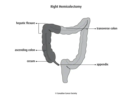 Diagram of a right hemicolectomy