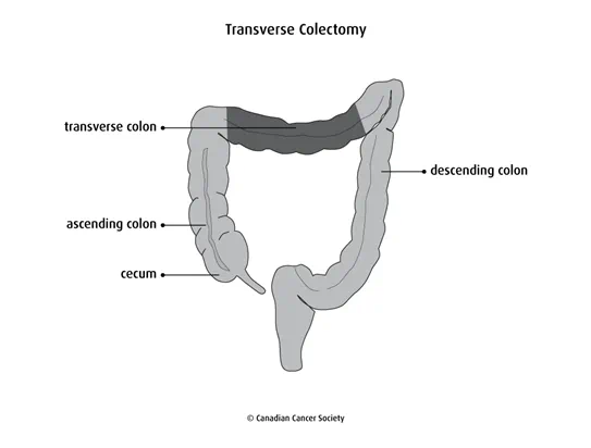 Diagram of a transverse colectomy