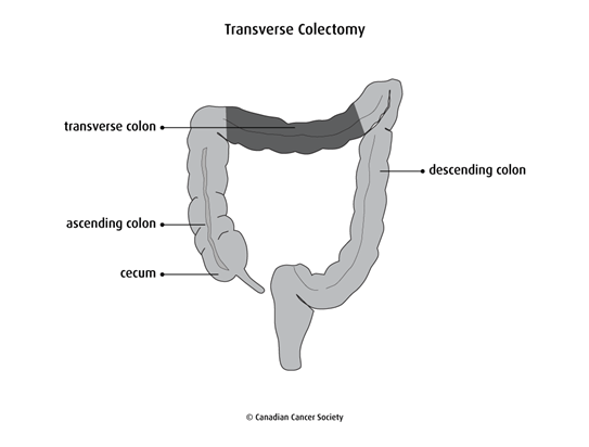 Colonectomy Incision Bowel resection | Canadian Cancer Society