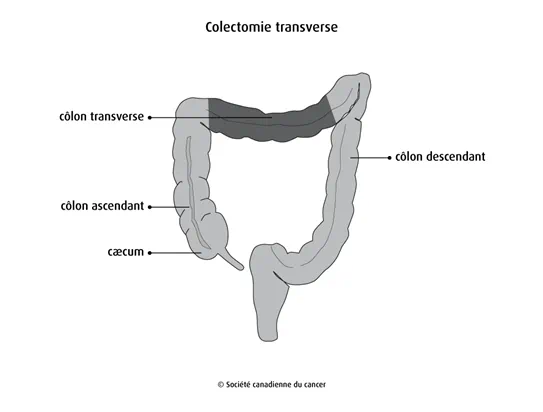 Colectomie transverse