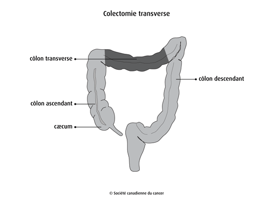 Colectomie transverse