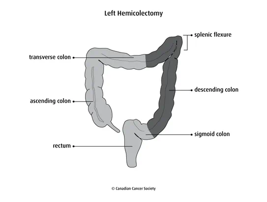 Diagram of a left hemicolectomy