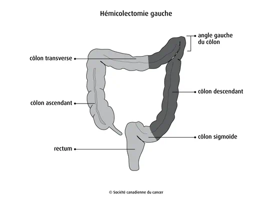 Hémicolectomie gauche