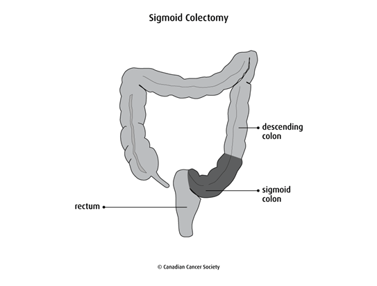 Diagram of a sigmoid colectomy