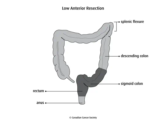 Diagram of a low anterior resection