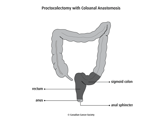 Diagram of a proctocolectomy with coloanal anastomosis