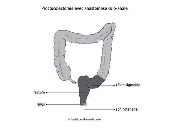 Proctocolectomie avec anastomose colo-anale