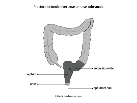 Proctocolectomie avec anastomose colo-anale