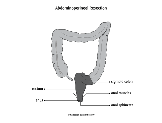 Diagram of an abdominoperineal resection