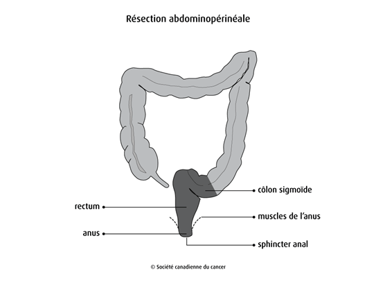 Schéma de la résection abdominopérinéale
