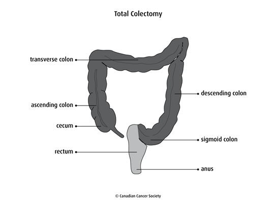 Bowel resection | Canadian Cancer Society
