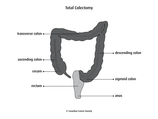 Diagram of a total colectomy