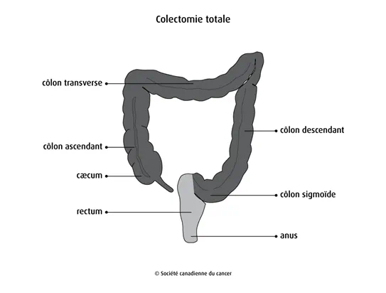 Colectomie totale
