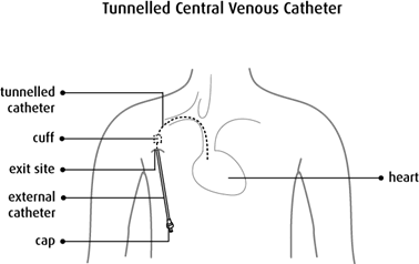 Tunnelled Central Venous Catheter