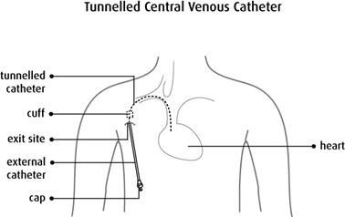 Tunnelled Central Venous Catheter