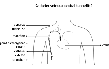 Cathéter veineux central tunnellisé