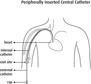 Peripherallly Inserted Central Catheter