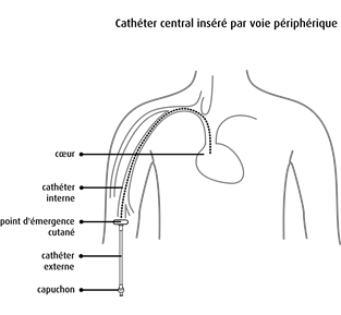 Cathéter central inséré par voie périphérique