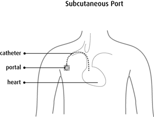 Subcutaneous Port