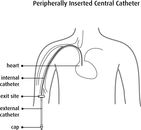 Peripherallly Inserted Central Catheter