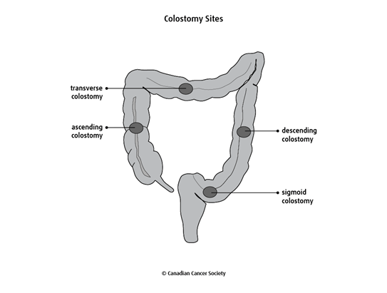 What is a stoma, Types of Stoma