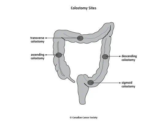 Diagram of colostomy sites