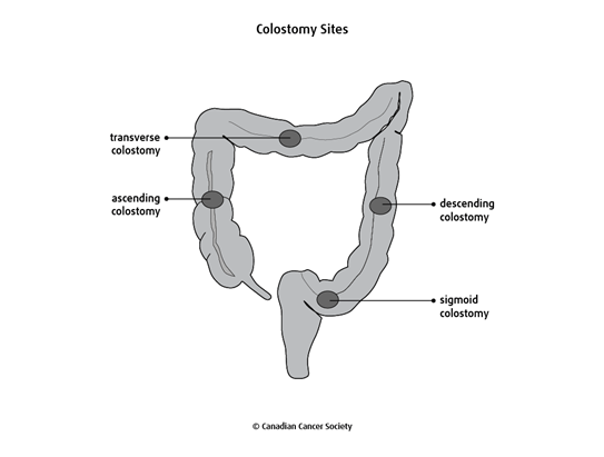 Colostomy and ileostomy | Canadian Cancer Society