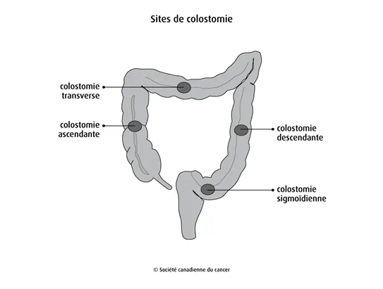 Schéma des sites de colostomie