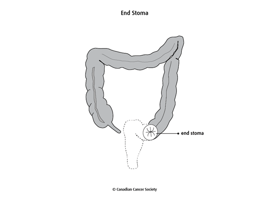 Colostomy and ileostomy | Canadian Cancer Society