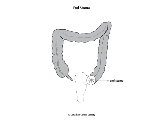 Diagram of an end stoma