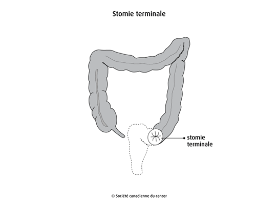 Schéma de la stomie terminale