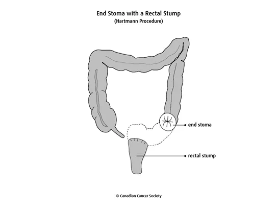 Diagram of an end stoma with a rectal stump