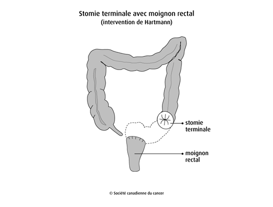 Stomie terminale avec moignon rectal