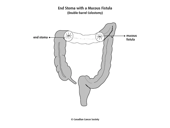 Diagram of an end stoma with a mucous fistula