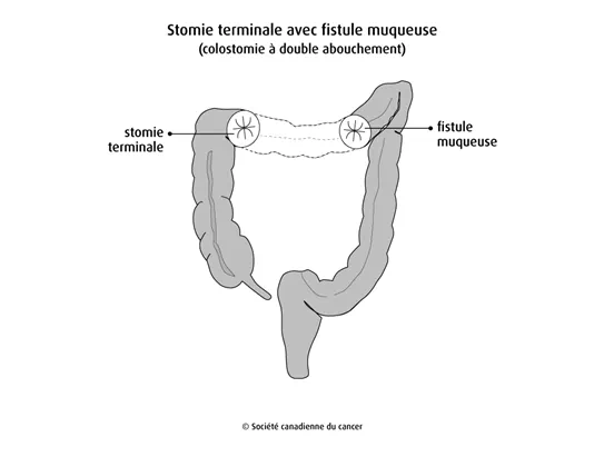 Stomie avec fistule muqueuse