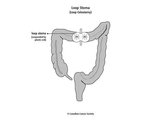 Diagram of a loop stoma