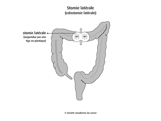 Stomie latérale