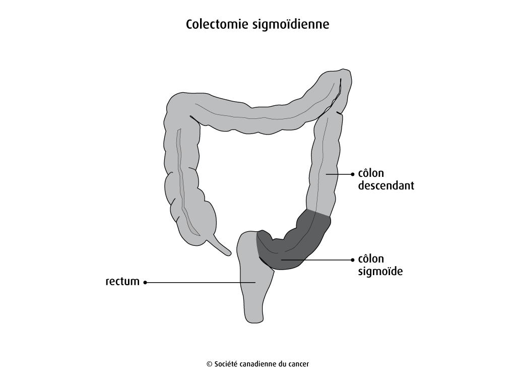 Schéma de la colectomie sigmoïdienne