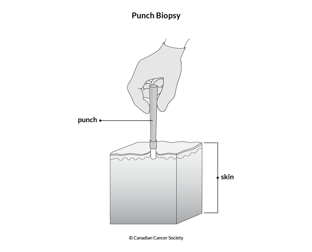 Diagram of a punch biopsy