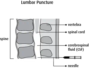 Graphic of lumbar puncture