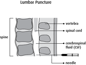 Graphic of lumbar puncture