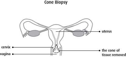 Cone Biopsy