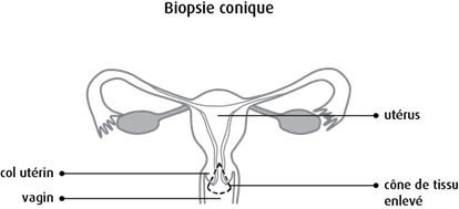 Biopsie conique