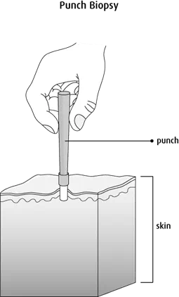 Diagram of a punch biopsy