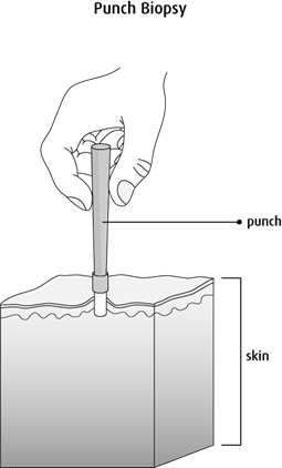 Diagram of a punch biopsy