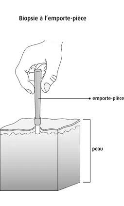 Biopsie à l’emporte-pièce