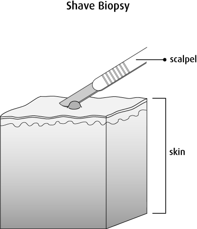 Shave Biopsy Canadian Cancer Society   9e9e82e0 C9ea 11ea 8e8b 0242df4d59be En 