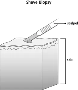 Diagram of a punch biopsy