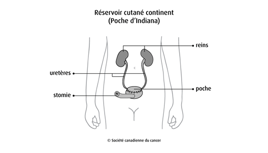Schéma d'un réservoir cutané continent (poche d'Indiana)
